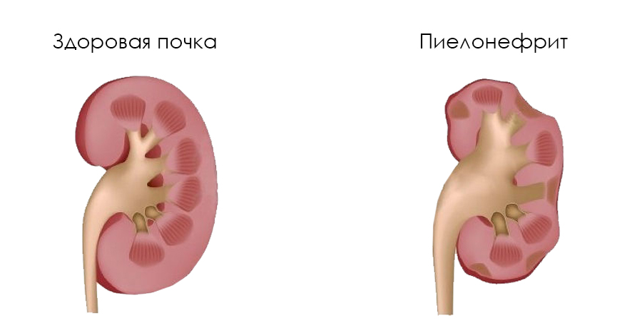 сбор мочи по зимницкому